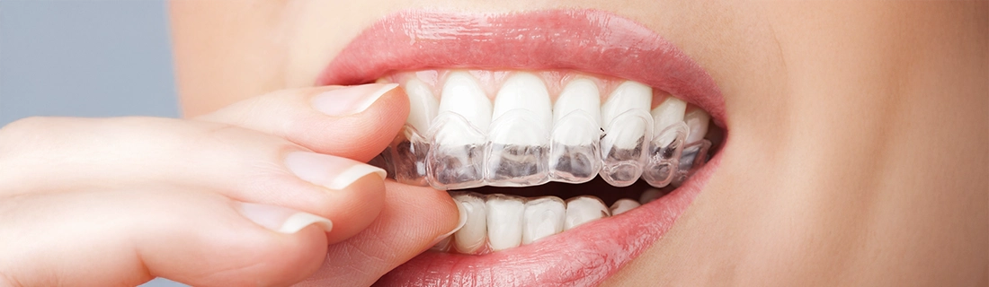 Clear Aligner Orthodontics