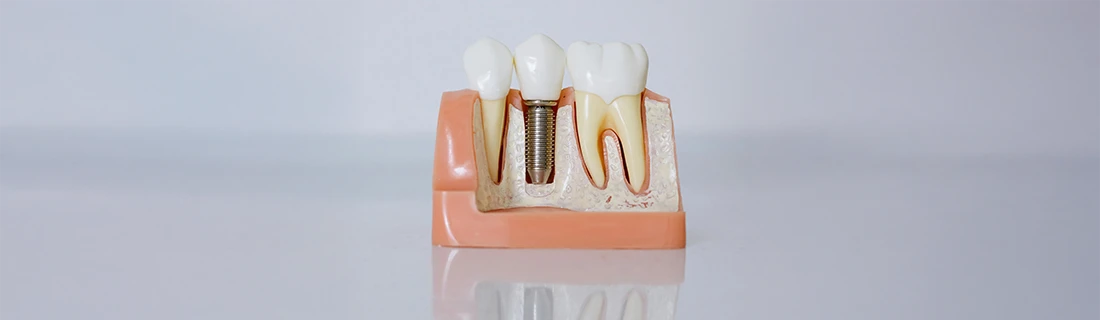 Dental Implant Analog