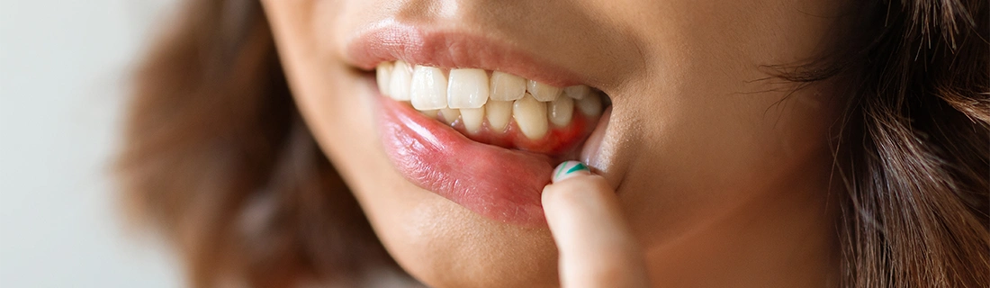 Woman With Inflammed Gums Showing Signs Of Oral Cancer