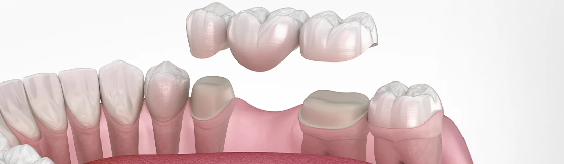 Dental Bridges in Oak Lawn IL