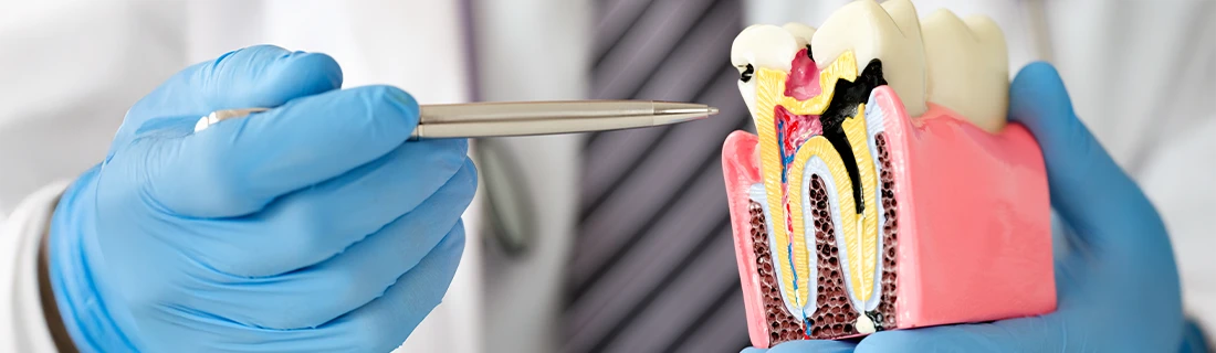 Root Canal Symptoms in Oak Lawn IL