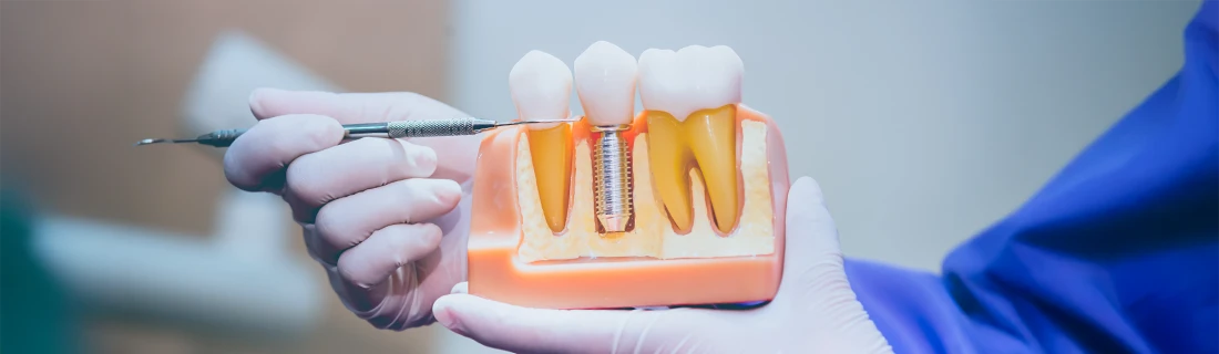 Dental Implant Benefits in Oak Lawn IL