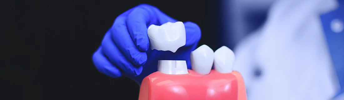 Dental Crowns in Oak Lawn IL